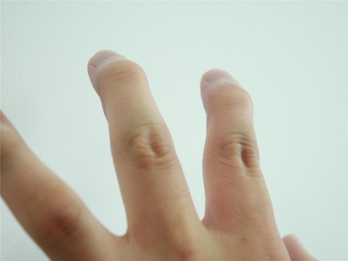 疾病导致的手指变形