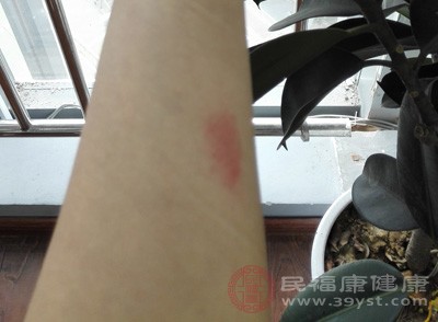 什么是疤痕體質 這樣做可以預防疤痕體質