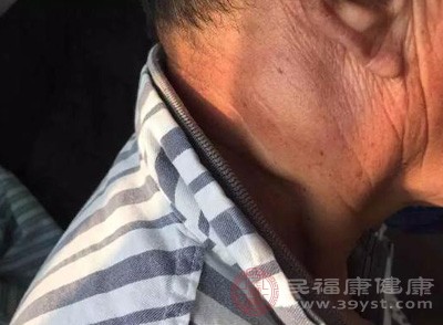 男子耳后长小疙瘩不在意 半年后检查已变癌症