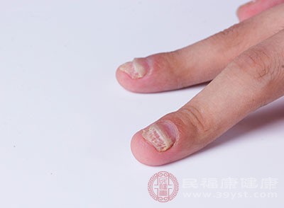 灰指甲的危害 这个病竟会影响日常生活