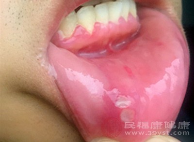 溃疡面较深较大，口腔不明原因的肿块应警惕口腔黏膜癌变可能
