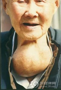 单纯性甲状腺肿_疾病库_民福康,三九养生堂