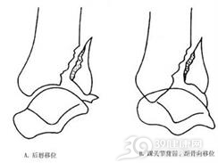 胫骨后唇骨折