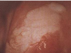 外阴白斑病 相关文章
