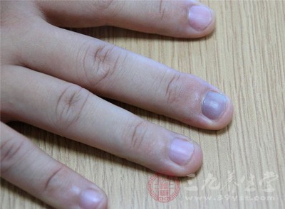 长灰指甲是什么原因 得了灰指甲这事得知道