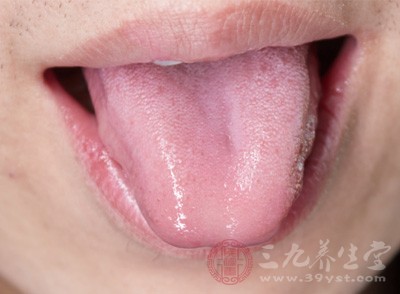 养生常识 舌头上有这表现多半是肾不行了