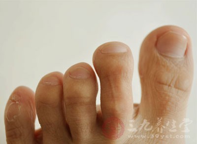 脚趾甲沟炎怎么治 患上甲沟炎用这偏方