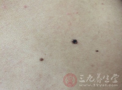 激光点痣 这样去除黑痣竟增加癌变风险(8)
