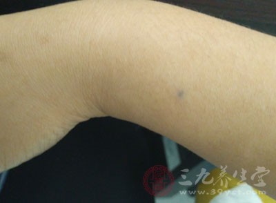 蜘蛛痣(spider angioma)是由一支中央小動脈及許多向外放散的細小血管形成