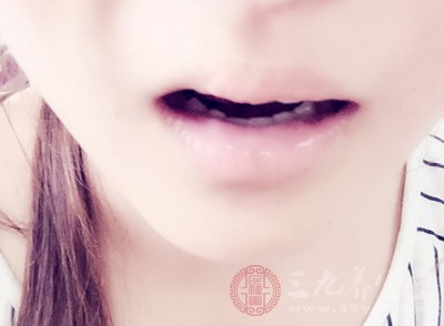 复发性口腔溃疡首先与免疫有着密切关系