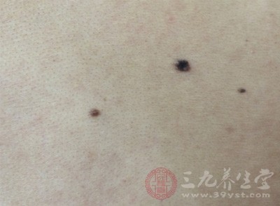 扁平疣是什么 根除扁平疣的偏方有哪些 - 民福