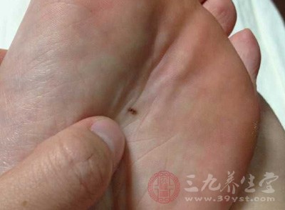 顏色較淡、部位較淺的痦子