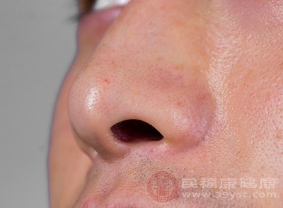 引起过敏性鼻炎多数是因为接触了过敏的物质