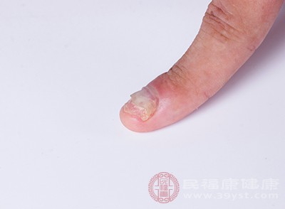 灰指甲其实并不仅仅局部于指甲上面