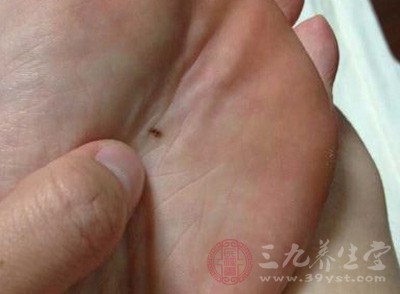 雞眼膏怎么用 如何正確使用雞眼膏