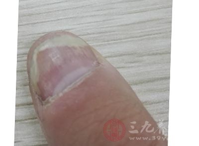 甲上出现黄色细点,则可能患上了消化系统的疾病 甲上出现黄色细点,则可能患上了消化系统的疾病