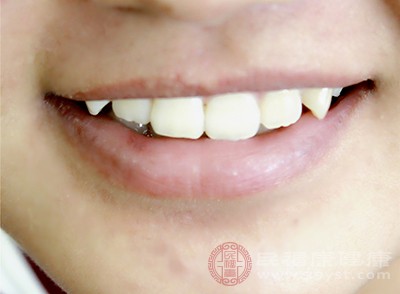 靠近牙龈处的牙齿因蛀牙形成了黑褐色的龋洞后