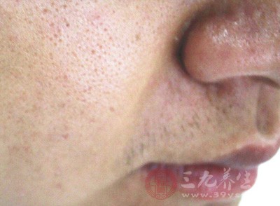 鼻翼长痘的原因 消除鼻翼上的痘痘