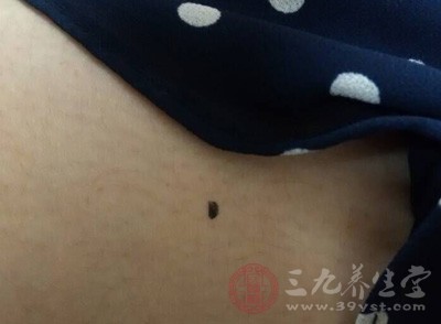 激光除痣可以控制佳光點的大小及深度，且不易留疤、不易感染