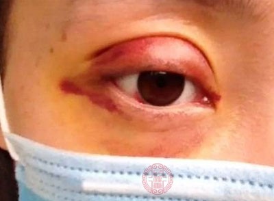 双眼皮手术,医学上面称之为重睑术 双眼皮手术,医学上面称之为重睑术