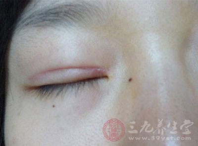 割双眼皮在术后会出现肿胀 割双眼皮在术后会出现肿胀