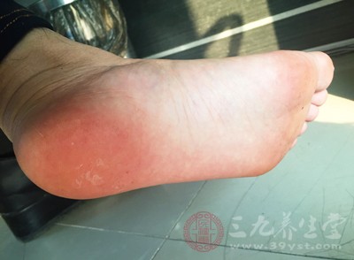 很多人都不明白為什么一到夏天就腳就會長小水泡