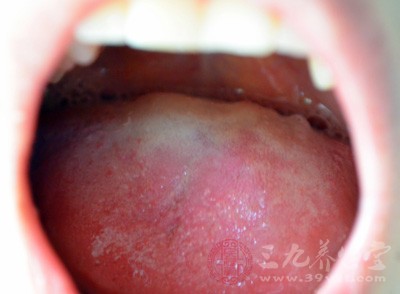 口腔溃疡是癌症吗 这五种口腔溃疡可能是癌症