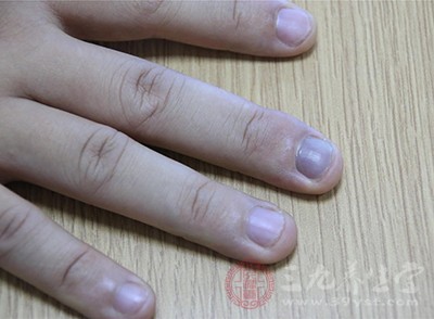 灰指甲的病因是什么 这些可以预防灰指甲