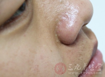 经常使用吸油纸并不能从根本上解决面部出油以及黑头的问题 经常使用吸油纸并不能从根本上解决面部出油以及黑头的问题