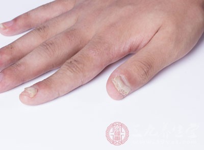 灰指甲的病因 这些因素竟导致灰指甲