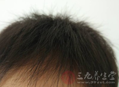 脱发严重