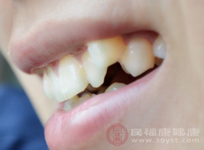 龋齿的危害 为啥说龋齿需要及时治疗