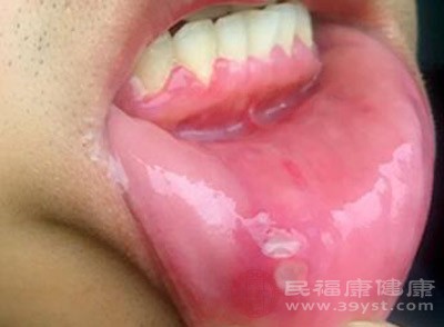 口腔癌的早期症状 有这些症状当心口腔癌