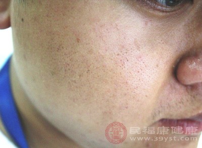 患者皮膚麻木、不出汗，特別是斑和斑塊處