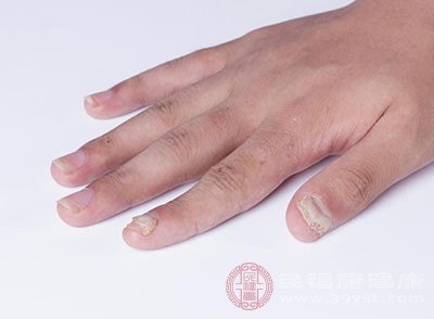 灰指甲症状 6种症状你见过几种
