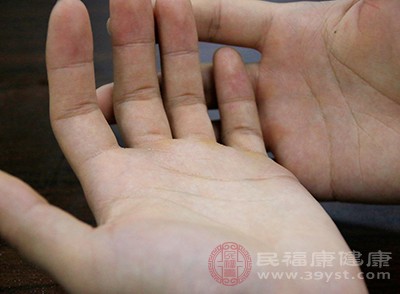 鳞屑水疱型是手足藓常见的一种症状