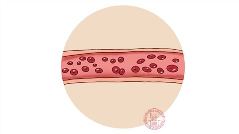 如果患者有幽閉恐懼癥或者腹內(nèi)壓?jiǎn)栴}，就要根據(jù)患者的情況決定是否可以進(jìn)行高壓氧治療