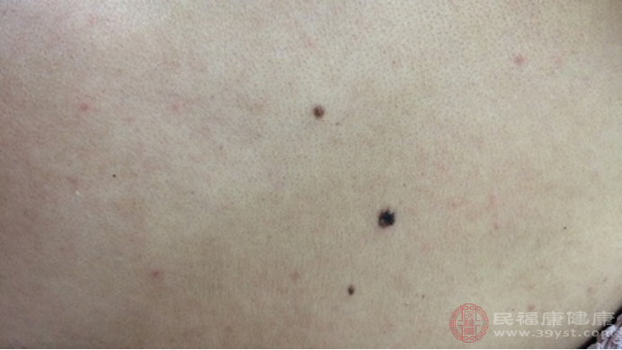 大家经常会在自己皮肤表面发现有黑色斑点