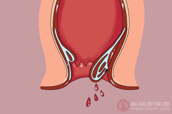 便血很可能是感染引起的，應(yīng)當(dāng)立即檢查