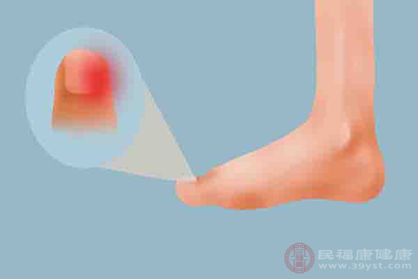脚指患有甲沟炎的患者在穿鞋或走路时脚趾会非常疼