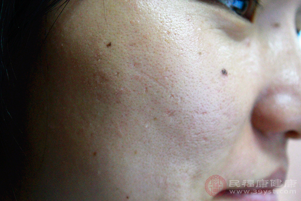 点痣以后皮肤会出现破损，这是皮肤的抵抗力和免疫力都会很差