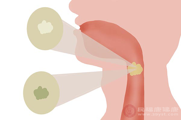 一般情況，在我們喉嚨內(nèi)就會(huì)有一些痰，但是并不多