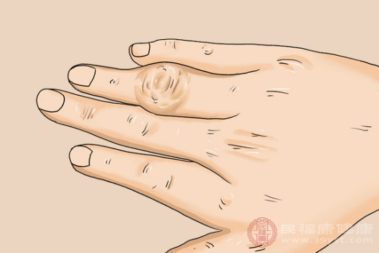 女性風(fēng)濕病患者所產(chǎn)生癥狀表現(xiàn)是很典型的