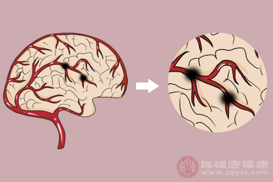 腦血栓前兆中比較常見的癥狀就是眩暈