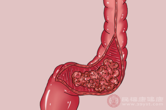 內(nèi)痔和直腸癌的區(qū)別，可以從自己一天排幾次便來區(qū)別