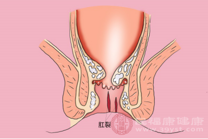 生活中很多人都有过该症状,由于肛门处的肌肉组织出现受损