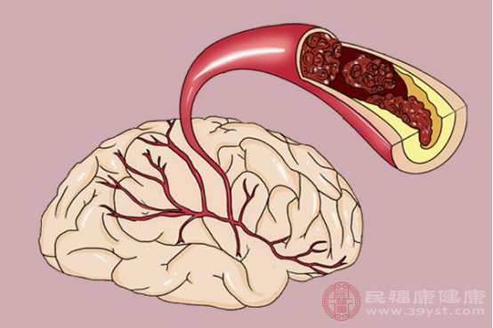 早期腦?；颊邥霈F(xiàn)頭部突然的發(fā)暈