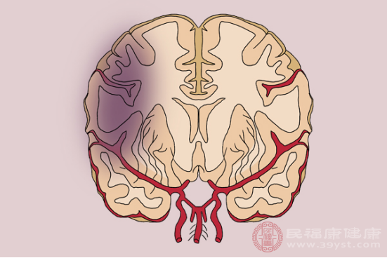 患有腦梗，大部分的患者會(huì)出現(xiàn)頭昏以及頭痛的癥狀