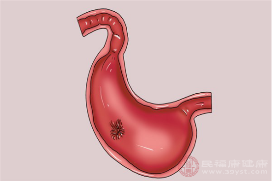 長時(shí)間處于焦慮或者傷心狀態(tài)中的人更容易得急性胃炎