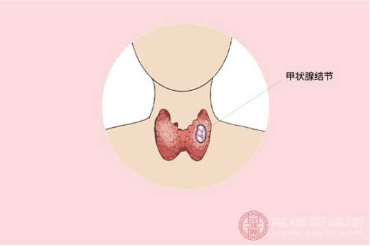 部分甲状腺结节患者可能有水肿,疼痛和心悸等症状